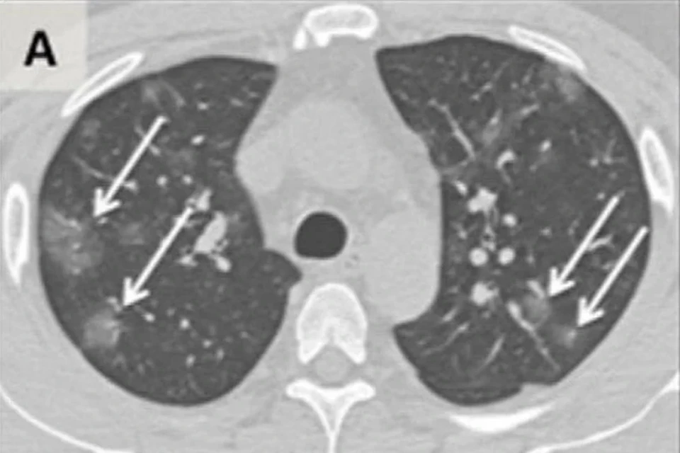 Фото: Cardiothoracic Imaging Division, Department of Radiology Perelman School of Medicine of the University of Pennsylvania