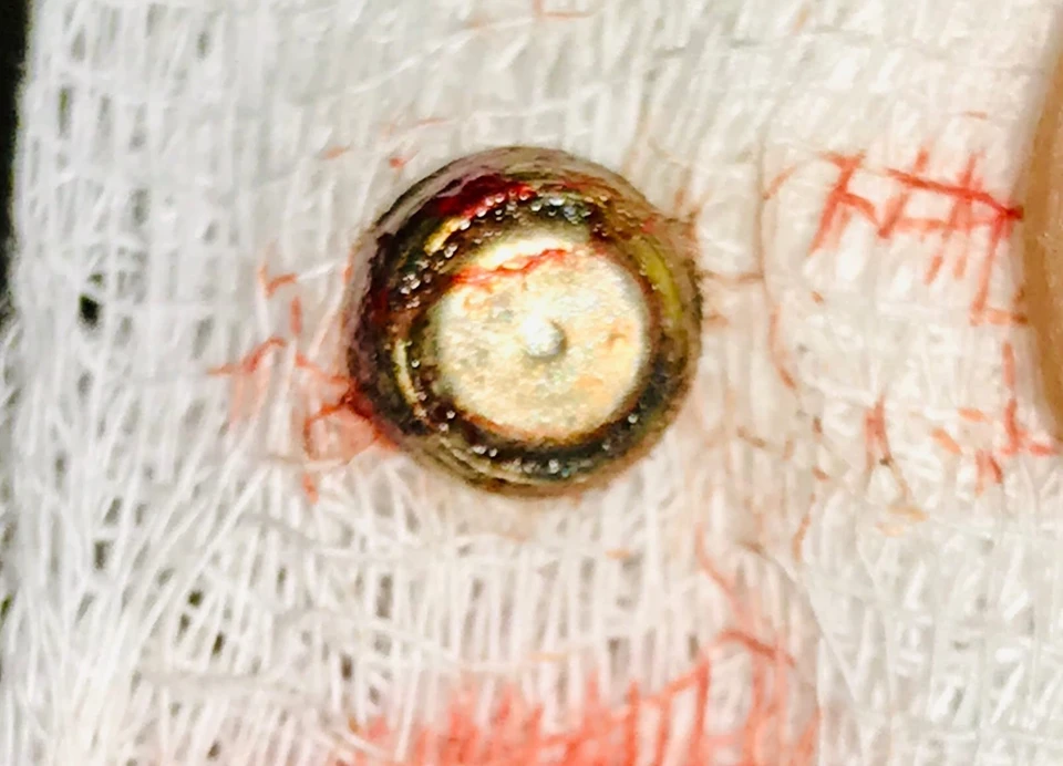 Ишимский врач извлек из носа малыша окислившуюся батарейку. Фото предоставлено ГБУЗ ТО «Областная больница №4».