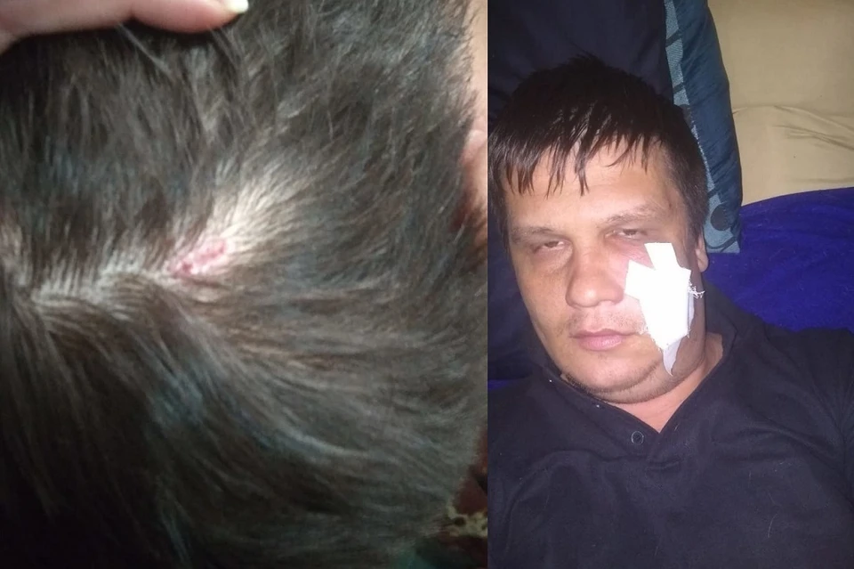 На голове у сибиряка остался шрам от удара обоймой. Фото: предоставлено героем публикации.