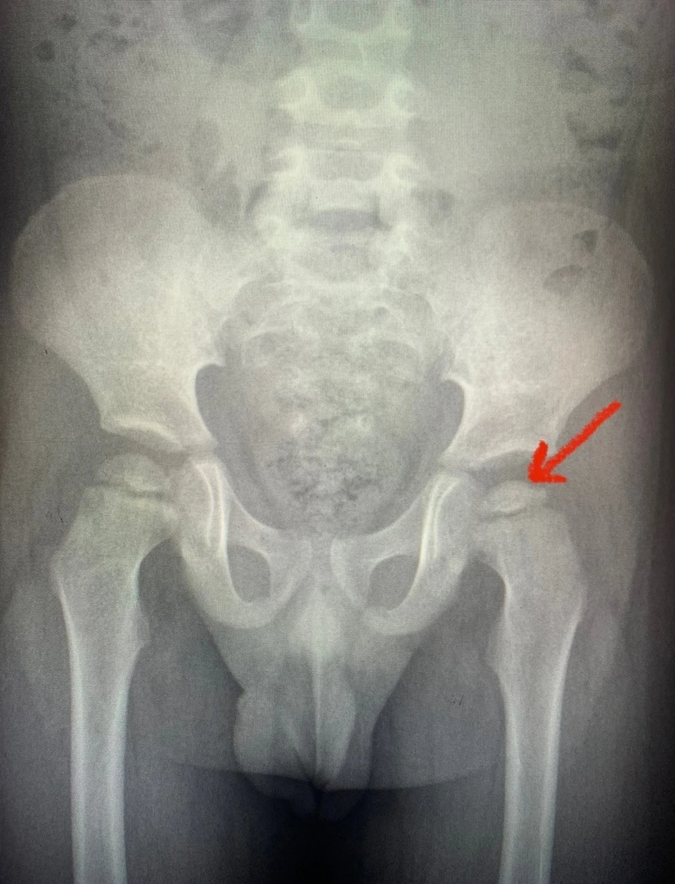 Рентгеновский снимок подтвердил редкую патологию тазобедренного сустава.
