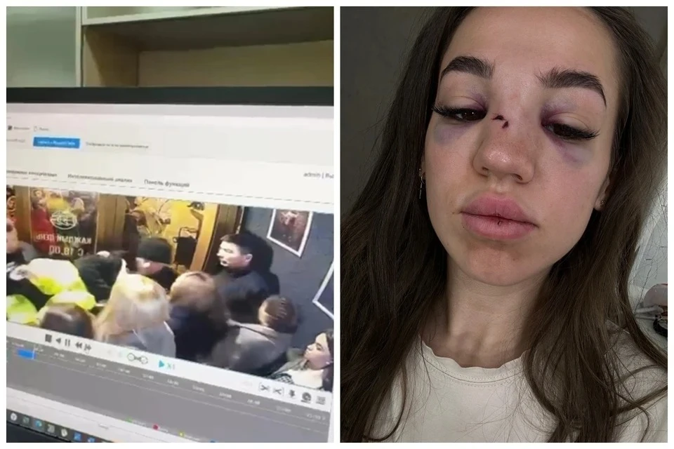 Мужчина, сломавший нос Ирине, до сих пор лично не извинился перед ней. Фото: Ирина Сердюк