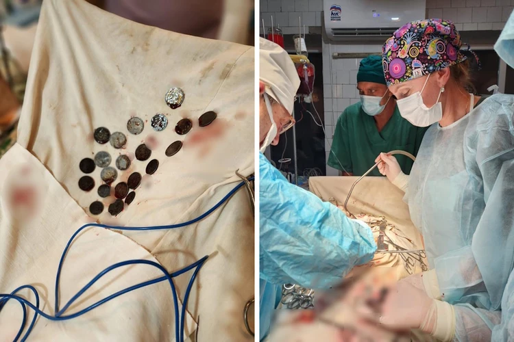 «Я нащупал что-то каменное!»: Из желудка жителя Донбасса достали 26 монет, которые он проглотил в детстве