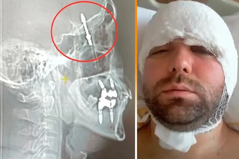 В Турции стоматолог случайно вкрутил зубной имплантат в мозг пациента