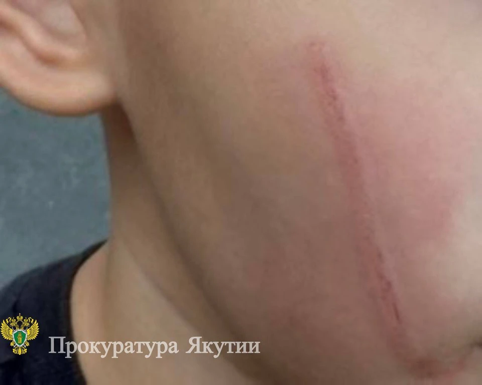 УК из Якутска заплатит ребенку за травмы из-за складирования стройматериалов Фото: прокуратура Якутии