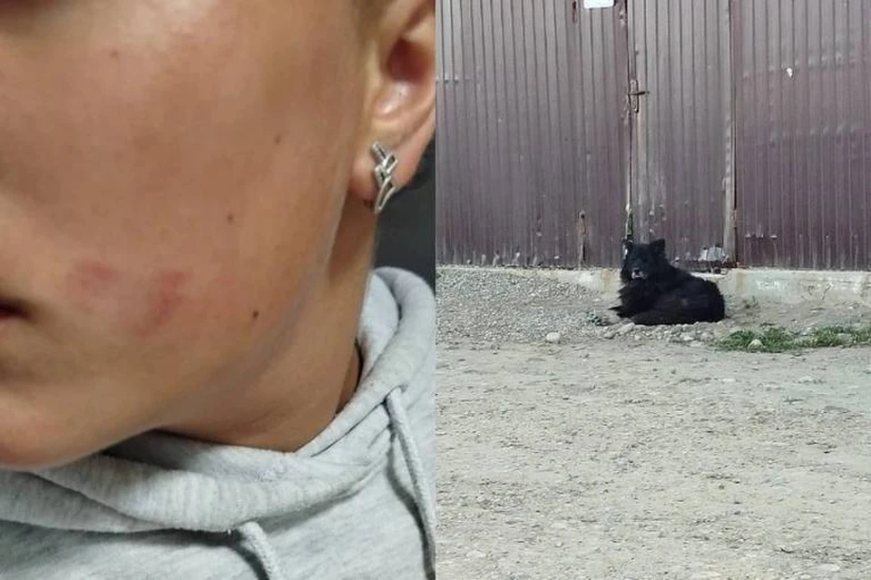 В Иркутском районе завели уголовное дело после нападения собаки на школьницу. Фото: личный архив матери пострадавшей.