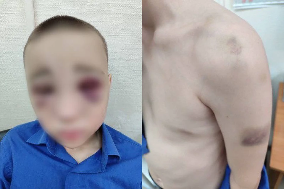 После полевого похода мальчик вернулся домой с гематомой. Фото: предоставлено КП-Новосибирск Викторией
