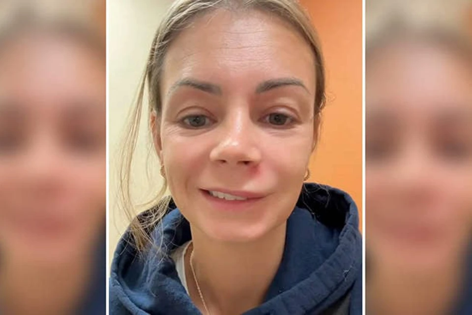 Девушка попала в больницу с параличом лица после выдавливания прыща