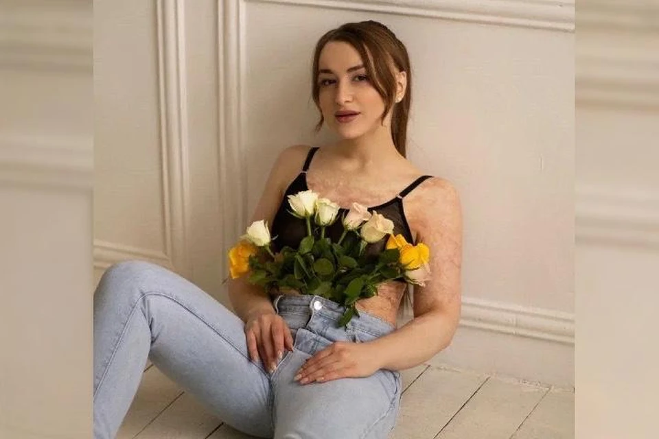 Когда Анне было пять лет, она получила страшные ожоги. Фото: личный архив.