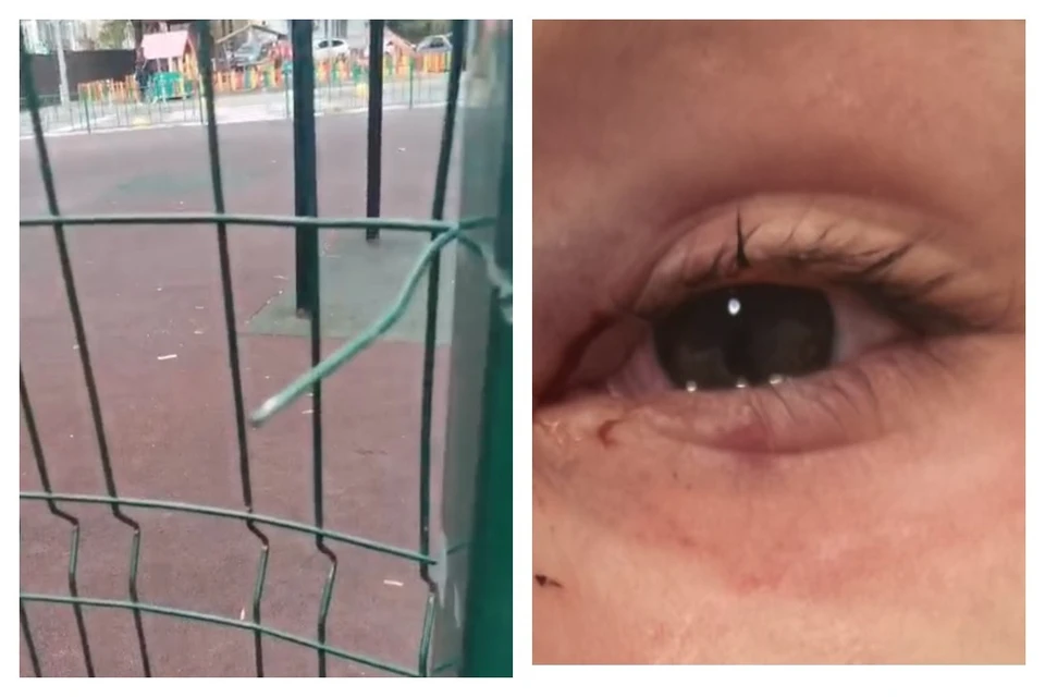 Мальчик получил травму глаза из-за опасного ограждения.