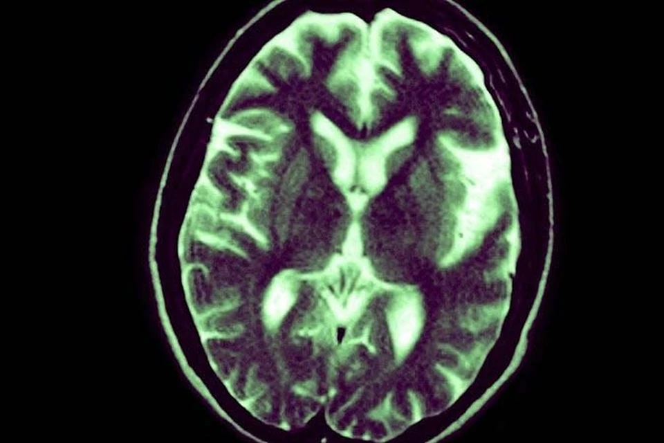 Альцгеймер у брюса. Alzheimer's disease MRI.