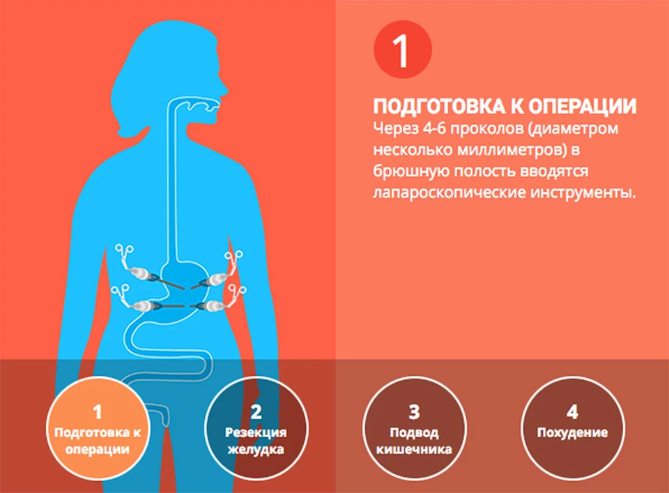 Шунтирование желудка (гастрошунтирование)