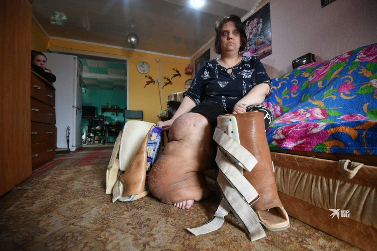 Самая тяжелая женщина в мире сбросила 250 кг после операции